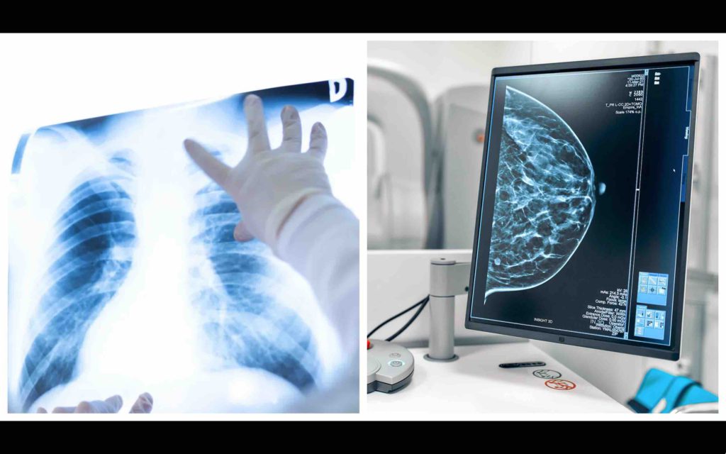 cancer du poumon cancer du sein Maroc